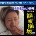 祐真キキの今現在の病気(顔面麻痺)の容態は手術して完治に向かっている?【仰天ニュース】
